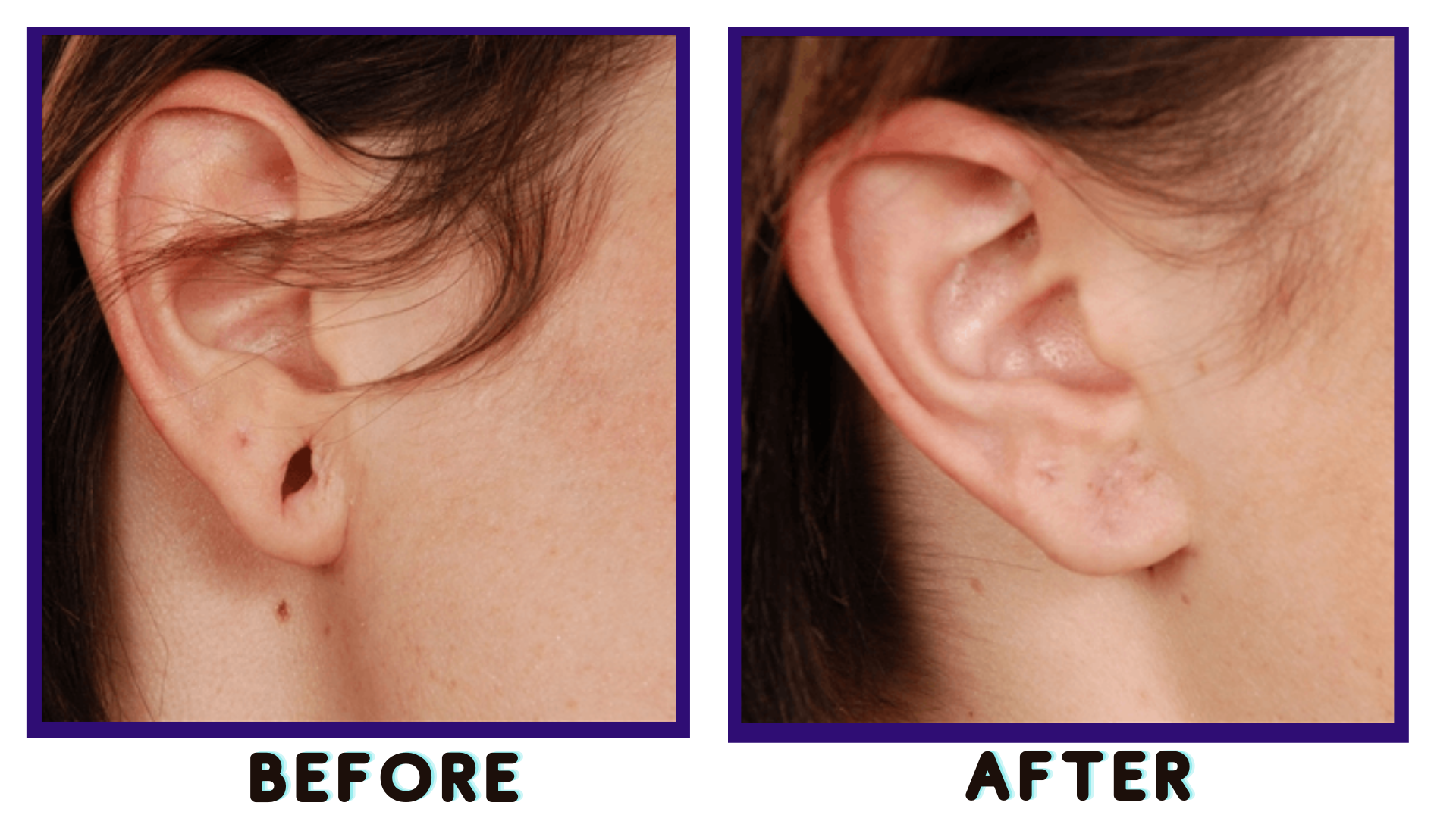 Earlobe repair & Piercing – Curves Cosmetic Surgery, Skin & Laser