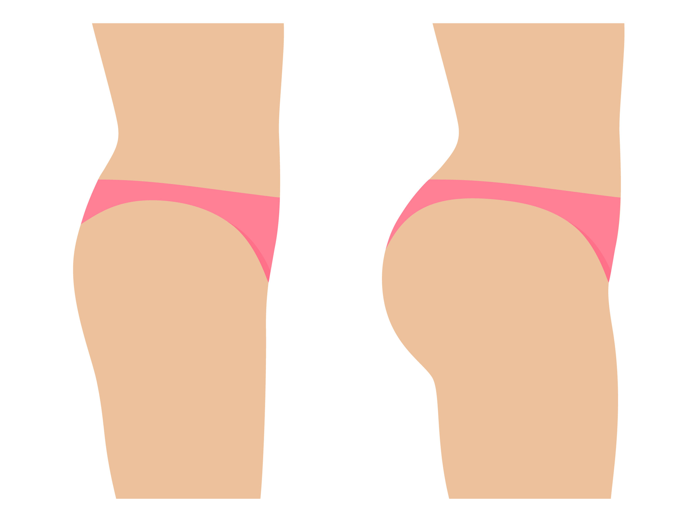 Everything you need to know about Gluteal Implants vs. Brazilian Butt Lift  Surgery